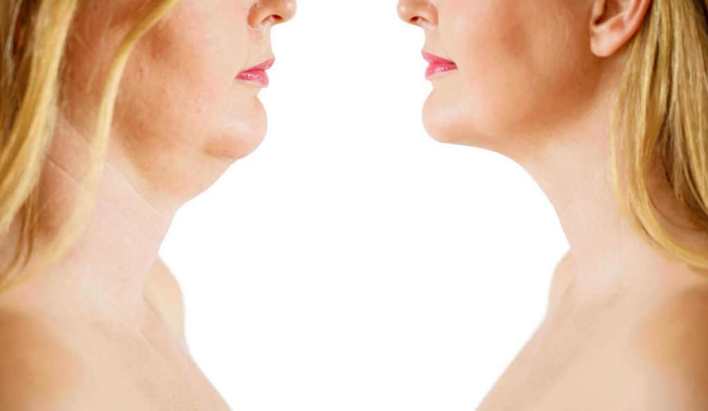 Double Chin treatment Greater London (Newham) before and after results