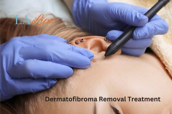 Dermatofibroma Removal Treatment Greater London (Newham)