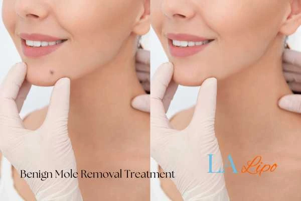 woman's before and after mole removal Greater London (Newham) results