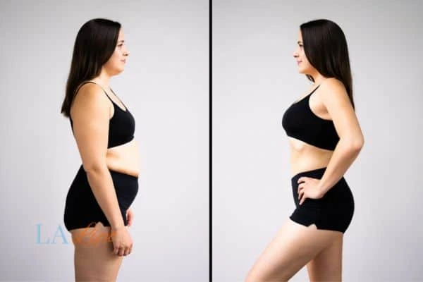 image of woman before and after results of LA-EMS Body Sculpting Greater London (Newham) to help treat Diastasis recti