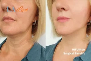 hi-fu for wrinkles Greater London (Newham) before and after results