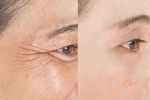 Before and after results of woman - HI-fu wrinkles reduction treatment Greater London (Newham)