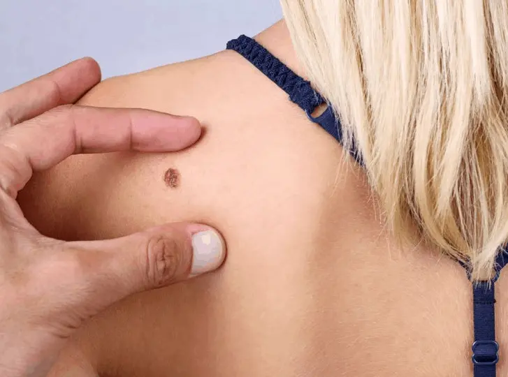 woman having mole removal Greater London (Newham) consultation before treatment.