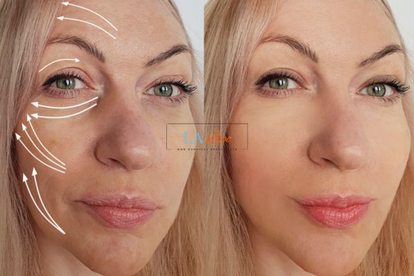 Morpheus 8 results Greater London (Newham) face lift.