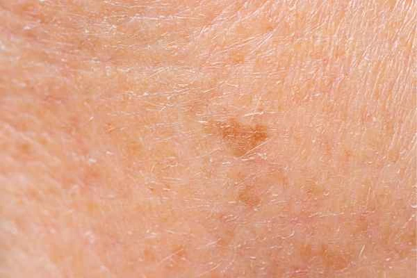 close up picture of age spots Greater London (Newham)